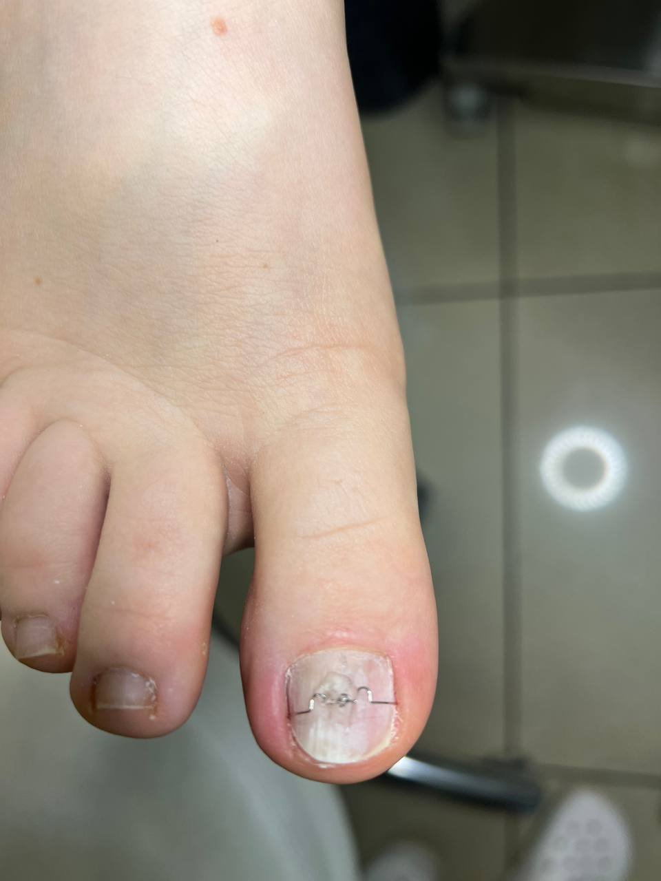 Титановa нитка за технікою 3ТО на нігті стопи — корекція врослого нігтя у подолога в Києві